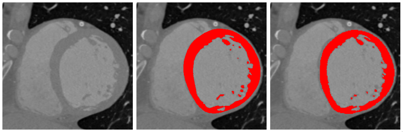 Figure 18: Visual comparison of manual (middle) and automated (right) segmentations of the left ventricular wall shown on one slice of a CT that was not used during the DL network’s fitting.