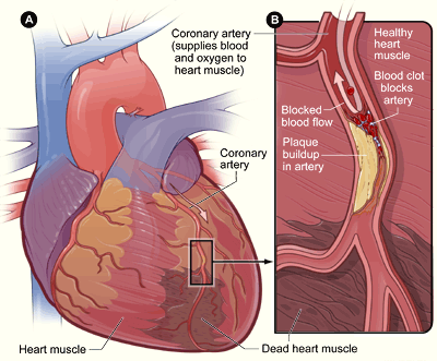 Figure 4: Infarct. [A] overview of the coronary system; [B] cross-section of the coronary artery with details on the occlusion process. In this thesis, we prefer the term “infarct scar” over “dead heart muscle,” and differenciate various levels of scar/healthy cell combinations throughout the organ. (illustration from https://www.nhlbi.nih.gov/health-topics/heart-attack, public domain)