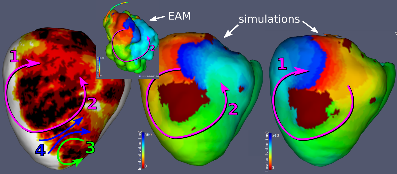 Patient 1: documented VT (CL=507 ms) vs simulated VT (CL=560 ms). 4 of the 7 simulated VT patterns are represented here. Pattern 2 is a clear match with the EAM and pattern 1 is a mirror reflection of the EAM.
