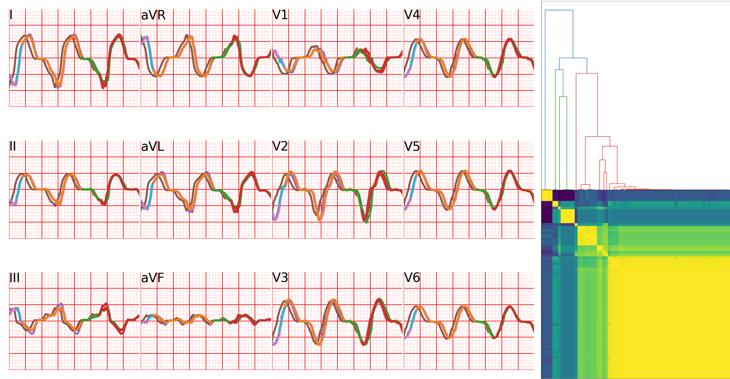 Figure 40: Clustering simulations outputs. Left part: superimposition of different simulated ECGs that have a circular cross-correlation above 0.95, forming a single cluster. Right part: distance matrix between all simulated ECGs for a patient, with the corresponding dendrogram.