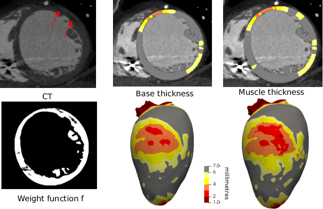 Figure 4: Myocardium-only thickness. From left to right: (top) CT image showing fat inclusions in the left myocardium (red arrows); (bottom) result of f(x); non-weighted thickness; weighted thickness showing more severe thinning. The thicknesses are shown both on a 2D slice (top) and projected on a surfacic mesh of the ventricular wall.