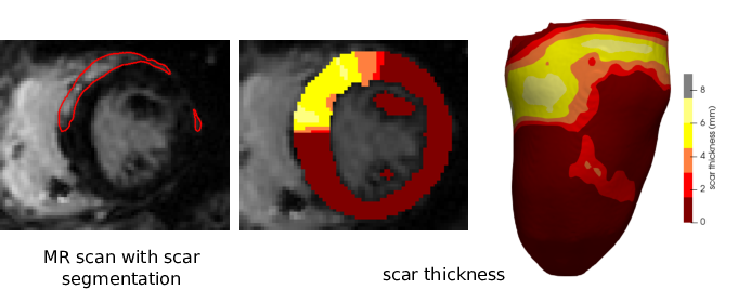 Figure 5: Scar thickness. From left to right: MR image with late gadolinium enhancement typical of scar tissue (outlined in red); scar thickness visualise overlayed on a MR slice; scar thickness projected on a surfacic mesh