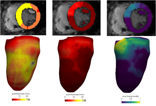 Figure 6: Scar transmurality. From left to right, total, total wall thickness, scar thickness, scar transmurality. Top images are overlay of the thickness values over the original MR image, bottom images are projections of the values on a surfacic mesh.